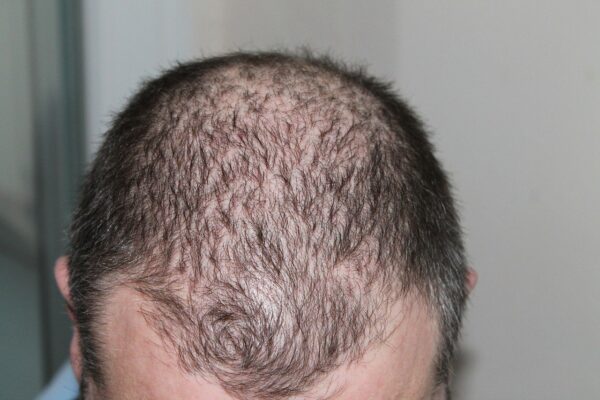 Good Hair Loss Treatment - Combat Your Hair Loss Problem