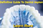 A Definitive Guide To Dental Implant Surgery