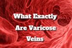 Veins Varicose What Exactly Are Varicose Veins