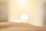 Acupuncture for Natural Recovery: Harnessing Its Benefits