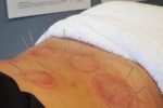 Sports Recovery Acupuncture: Discover 6 Essential Benefits