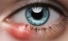 Eye Styes: Causes and Effective Home Remedies for Relief
